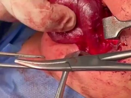 Le Trajet du Nerf Récurrent au Sein de la Thyroïde