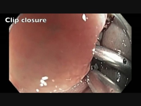 Côlon: Résection Muqueuse Endoscopique compliquée d'une perforation - partie 8