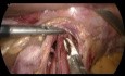 Cardiomyotomie Heller laparoscopique
