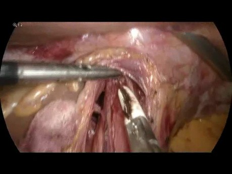 Cardiomyotomie Heller laparoscopique