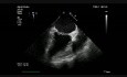Endocardite infectieuse sur valve mitrale