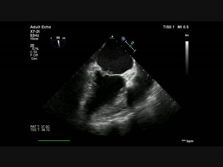 Endocardite infectieuse sur valve mitrale