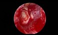 Tympanoplastie Endoscopique en Cartilage Papillon pour Perforation Tympanique