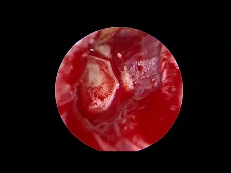 Tympanoplastie Endoscopique en Cartilage Papillon pour Perforation Tympanique