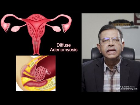 Fibrome et adénomyose - quelle est la différence?