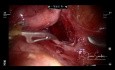 Chirurgie robot-assistée dans le traitement de l'uretère ectopique