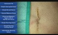 Surjet intradermique - les techniques de la suture