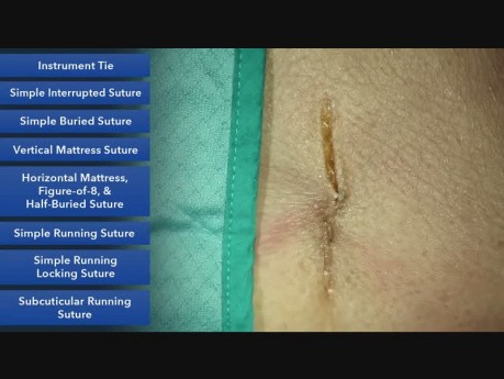 Surjet intradermique - les techniques de la suture