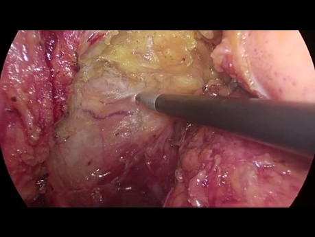 Excision mésorectale totale (EMT) laparoscopique avec bistouri électrique à crochet monopolaire