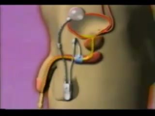 Sphincter urinaire artificiel - Animation