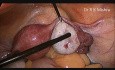 Cœlioscopie avec épreuve au bleu tubaire et drilling ovarien 