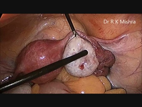 Cœlioscopie avec épreuve au bleu tubaire et drilling ovarien 
