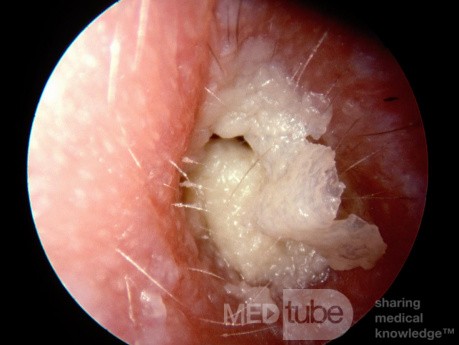 Otite externe chronique, débris de kératine