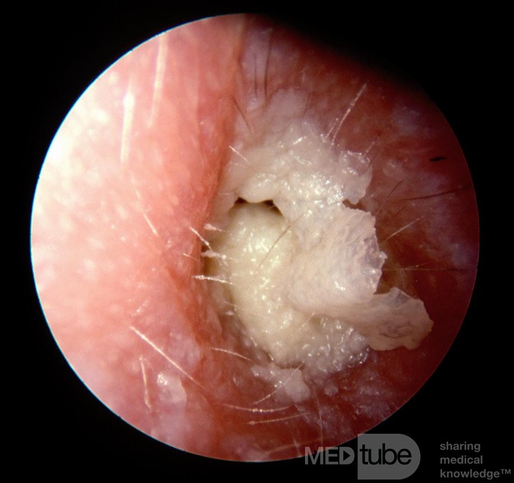 Otite externe chronique, débris de kératine