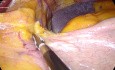 Mini-bypass gastrique laparoscopique