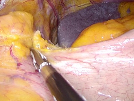 Mini-bypass gastrique laparoscopique