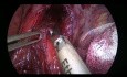 Cardio-myotomie pour récidive d'Achalasie après l'échec de trois tentative de dilatation pneumatique