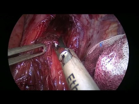 Cardio-myotomie pour récidive d'Achalasie après l'échec de trois tentative de dilatation pneumatique