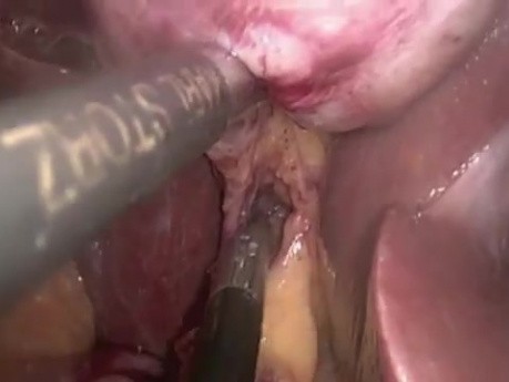 Cholécystectomie laparoscopique par incision unique avec usage d'un rétracteur