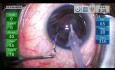 Chirurgie de la cataracte avec pseudoexfoliation