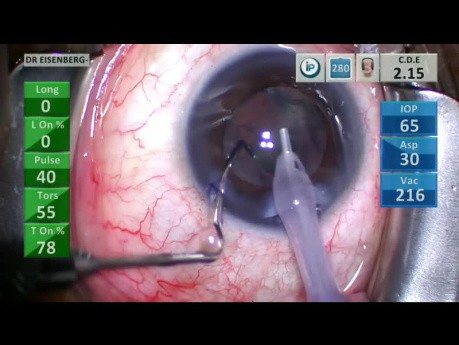 Chirurgie de la cataracte avec pseudoexfoliation