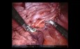 Plicature diaphragmatique assistée par robot