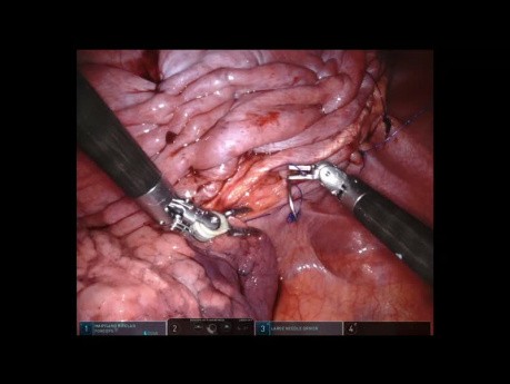 Plicature diaphragmatique assistée par robot