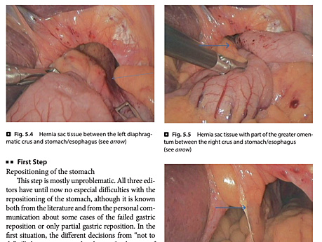 Opérations gastro-intestinales et variations techniques