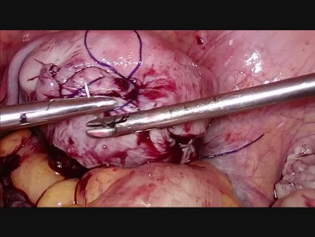 Aquadissection pour une ablation des fibromes multiples par myomectomie