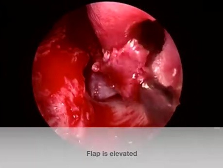 Réparation Endoscopique de Perforation Septale