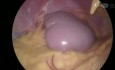 Splénectomie Laparoscopique 