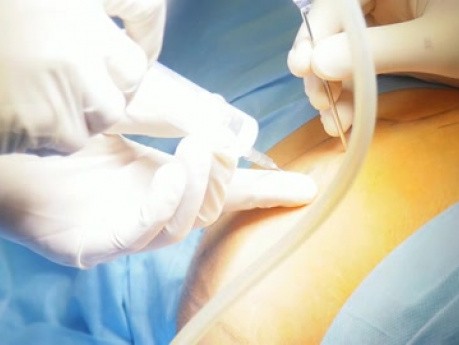 La surrénalectomie laparoscopique