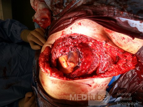Défaut tissulaire dans la paroi thoracique, le péricarde reste intact après l'exérèse du liposarcome du sein gauche