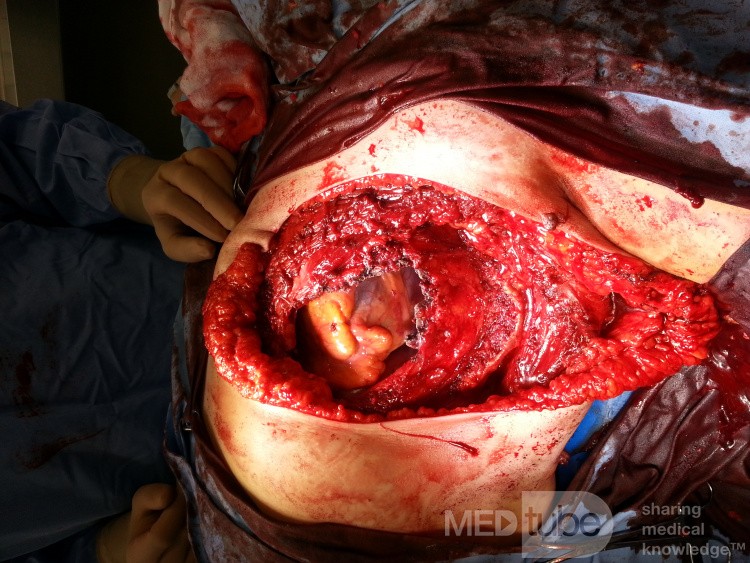 Défaut tissulaire dans la paroi thoracique, le péricarde reste intact après l'exérèse du liposarcome du sein gauche