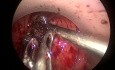 (TAMIS) Traitement Transanal de la Fistule Recto-Vésicale après Résection Antérieure Basse pour Cancer du Rectum