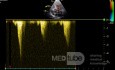 Cardiomyopathie hypertrophique de la voie de sortie ventriculaire gauche - Le Doppler continu