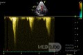 Cardiomyopathie hypertrophique de la voie de sortie ventriculaire gauche - Le Doppler continu