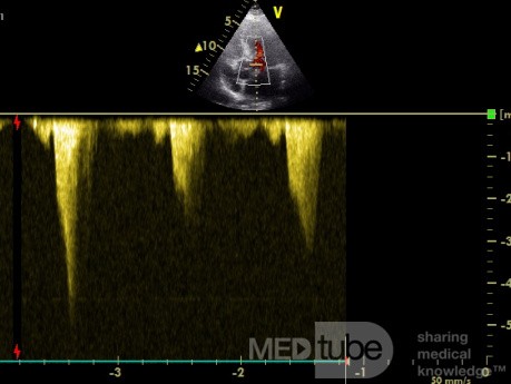 Cardiomyopathie hypertrophique de la voie de sortie ventriculaire gauche - Le Doppler continu