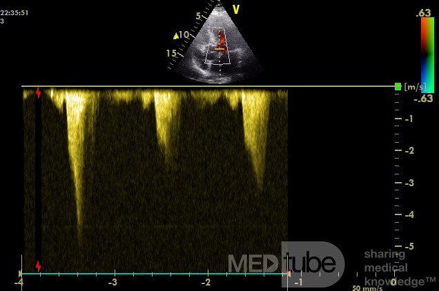 Cardiomyopathie hypertrophique de la voie de sortie ventriculaire gauche - Le Doppler continu