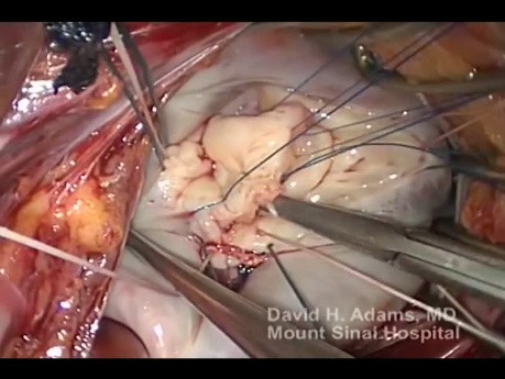 Réparation de la Valve Mitrale en cas de Dégénérescence Fibroélastique