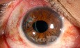 Traumatisme oculaire contondant. Phaco-trabéculectomie. Chirurgie de l'iris.