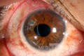 Traumatisme oculaire contondant. Phaco-trabéculectomie. Chirurgie de l'iris.
