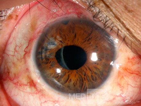 Traumatisme oculaire contondant. Phaco-trabéculectomie. Chirurgie de l'iris.