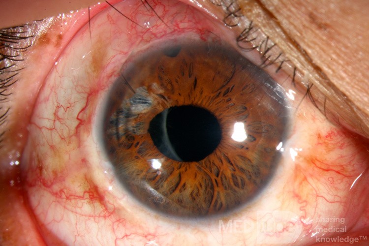 Traumatisme oculaire contondant. Phaco-trabéculectomie. Chirurgie de l'iris.