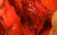 Hystérectomie radicale Résection du ligament vésico-utérin