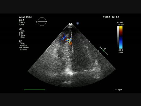 Rupture du septum interventriculaire après IDM de la paroi antérieure