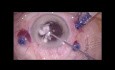 Subluxation post-traumatique d'un implant intraoculaire (IOL)