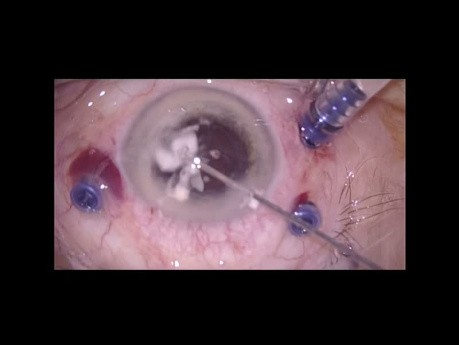 Subluxation post-traumatique d'un implant intraoculaire (IOL)