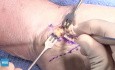OrthoApproach - Libération/Décompression du Canal Carpien - Approche et Technique Chirurgicales