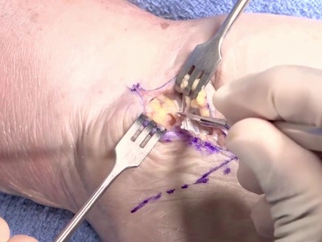 OrthoApproach - Libération/Décompression du Canal Carpien - Approche et Technique Chirurgicales